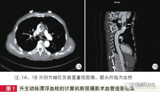 【病例报告】心悸，原来是因为它！