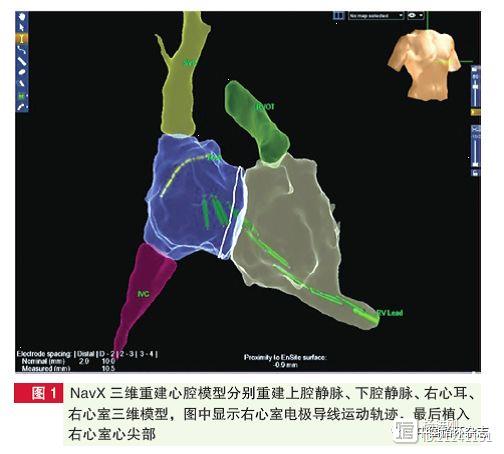 阜外医院为孕妇装起搏器：仅透视14秒