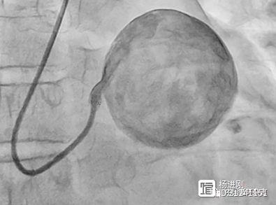 新英格兰医学杂志病例：这么大的左主干动脉瘤您见过吗？