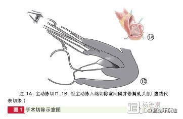 阜外医院480例心肌切除治疗肥厚梗阻心肌病经验：还可有效缓解二尖瓣反流