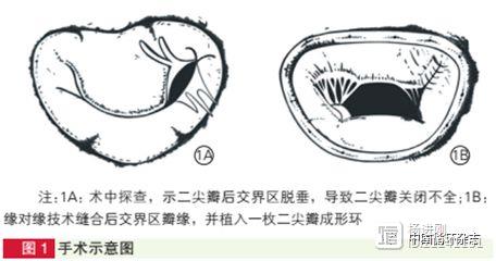 阜外研究新技术治疗二尖瓣脱垂简单有效