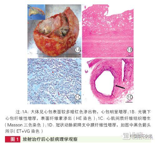 阜外医院病例：中年女性乳腺癌放疗，20年后需要心脏移植