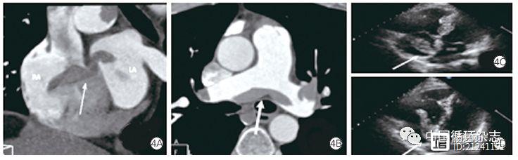 武汉亚心医院研究称，鉴别黏液瘤，冠脉CT和超声各有优势