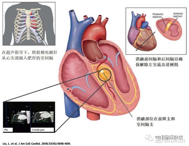 JACC刊登西创新！超声引导室间隔射频可治疗梗阻性肥厚心肌病