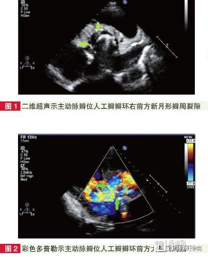 阜外医院研究：感染性心内膜炎和血管炎是换瓣术后瓣周漏的重要原因