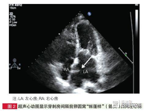 阜外医院不开刀、不用射线实施二尖瓣球囊扩张经验：超声引导更具优势