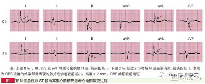 盛学者研究发现，心梗患者心电图QRS波有转折或切迹，或提示预后不佳