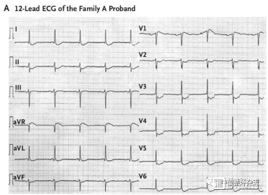 新英格兰医学杂志病例报告：持续30年ST段压低追踪，一个新的疾病出世