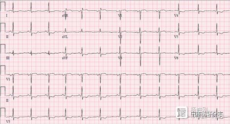 JAMA病例：年轻产妇胸痛，广泛ST段压低，心肌酶升高