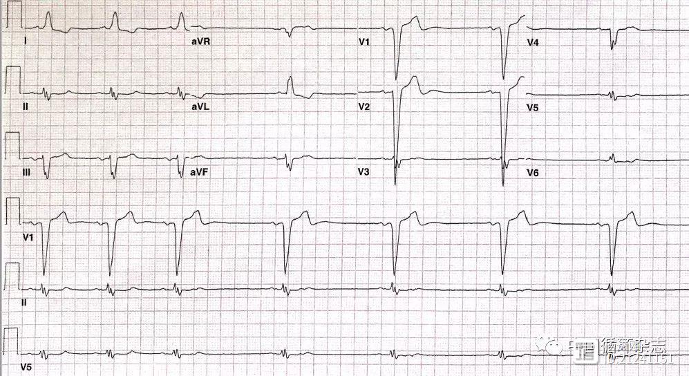 【ACC心电图培训】不简单的“简单”心电图