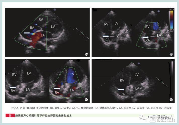 阜外医院研究：不“吃”线封堵卵圆孔未闭安全有效