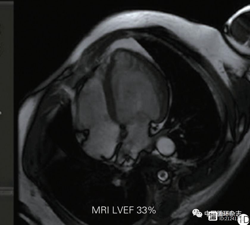 牛了！阜外医院用心脏超声3D成像测心功能，效果堪比核磁共振