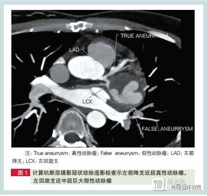 兰大一院病例：口腔溃疡伴冠状动脉瘤