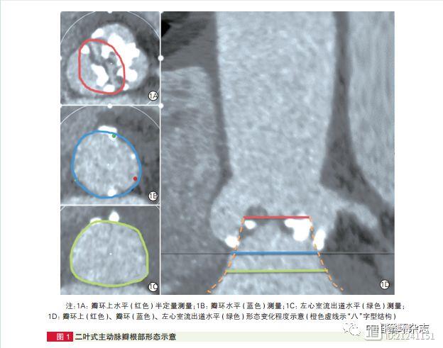 TAVR 治疗二叶式主动脉瓣狭窄：主动脉根部形态影响瓣膜置入