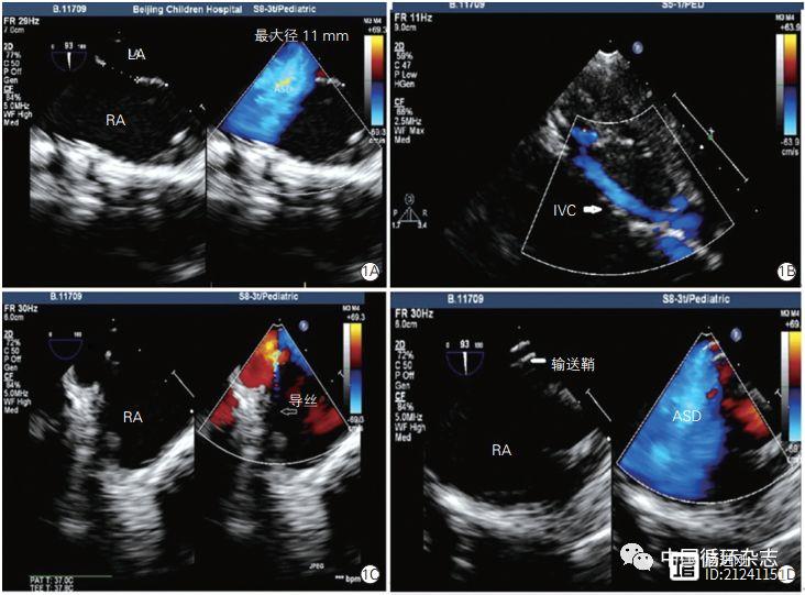 国家儿童医学中心研究：超声引导介入封堵儿童房缺安全有效