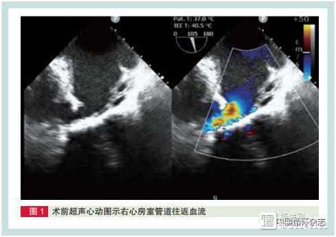 阜外医院潘湘斌等解决“烫手山芋”：超声指引下“不开胸”换三尖瓣