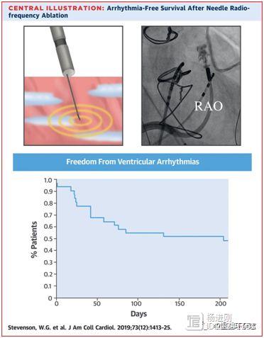 JACC杂志称，射频消融有了针刺导管，专治心律失常激动点隐藏太“深”