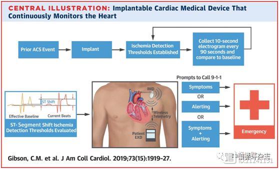 JACC研究试水植入式心脏警报系统：预测心梗有潜力