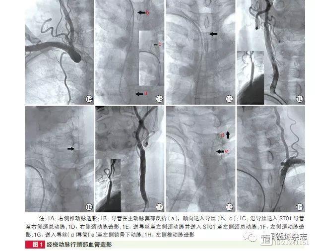 厦门长庚医院医生称，经桡动脉也可进行颈动脉介入治疗