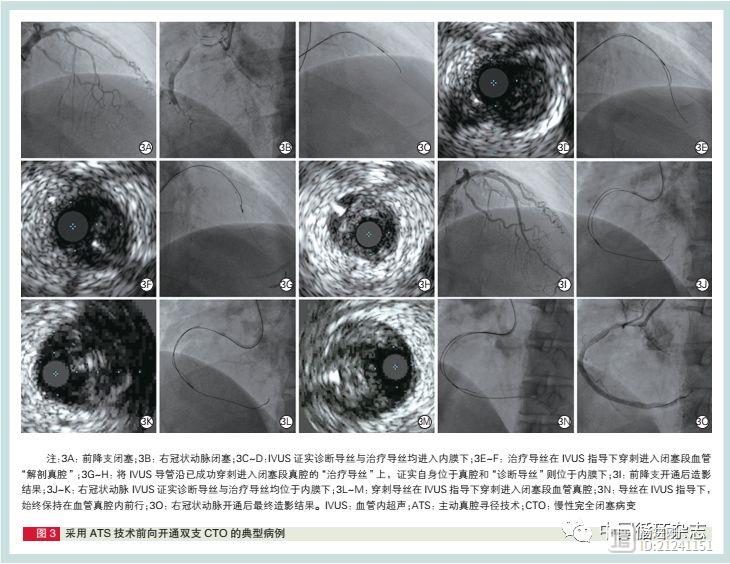 阜外医院杨跃进团队完美解决复杂CTO难题：IVUS-ATS技术具有重要补充价值