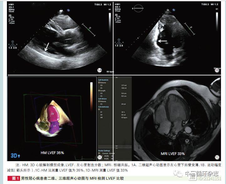 阜外医院研究称：心脏超声三维成像评估心功能，效果堪比核磁共振