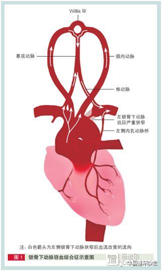 阜外医院蒋雄京等推出锁骨下/椎动脉狭窄处理专家共识：判断大动脉炎推荐使用阜外标准，搭桥时警惕锁骨下动脉窃血