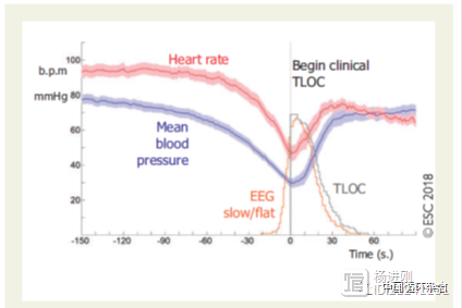 2018 ESC 晕厥诊断与处理指南临床实践指导（第六部分）：直立倾斜试验