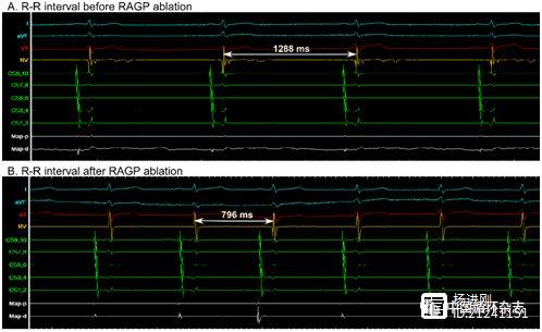 阜外医院姚焰团队Heart Rhythm发文：右前神经节丛是血管迷走性晕厥和缓慢性心律失常的重要治疗靶点