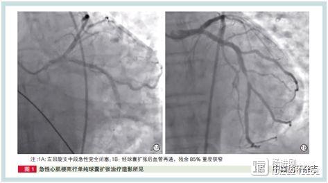 徐州三院张瑶俊等病例报告：药物涂层球囊治疗心梗有潜力