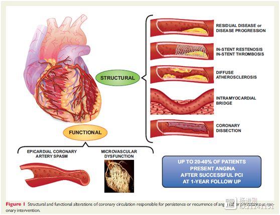介入治疗后心绞痛未缓解或复发怎么办？欧洲心脏杂志文章称：可考虑十种情况