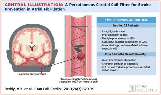 JACC秀房颤预防脑卒中新装置：在颈动脉放线圈捕获血栓