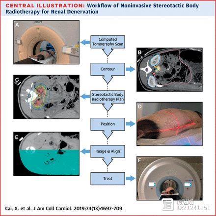 JACC刊登上海新华医院李毅刚等动物研究：立体定向放疗去肾交感神经术有效可行