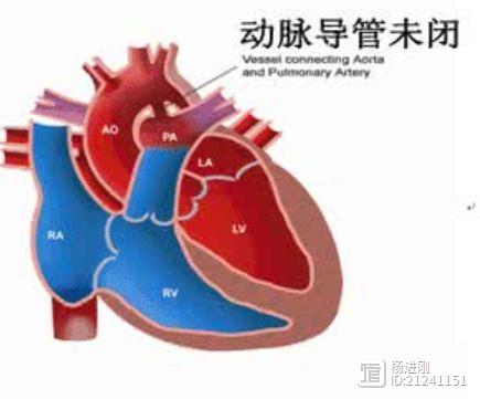 儿童0射线封堵动脉导管未闭安全可行！北京儿童医院研究：不适合者可小切口手术