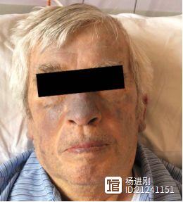 新英格兰医学杂志病例：房颤患者皮肤变色，原来是因这种药