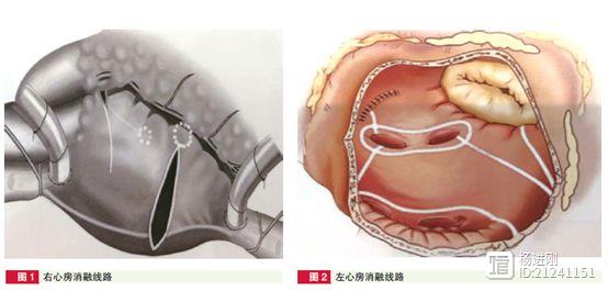 安贞医院心脏手术同期Cox迷宫Ⅳ手术治疗房颤经验