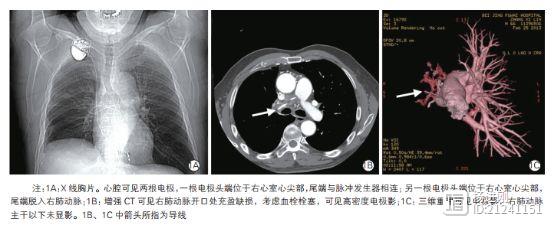 心腔内多根废弃导线要警惕！阜外医院华伟等病例报告