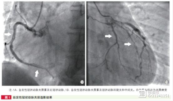 阜外医院乔树宾等研究称，仅1/3自发冠脉夹层为女士，多数可药物保守治疗