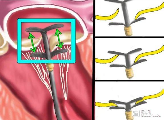 即刻起效，仅需超声引导！葛均波院士等报告自主研发ValveClamp治疗二尖瓣反流经验
