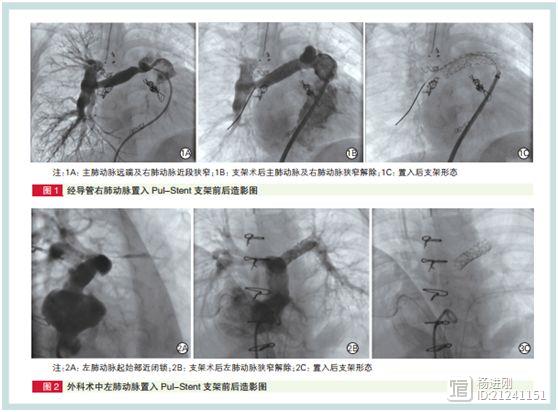 新型肺动脉支架治疗肺动脉狭窄安全有效！阜外医院研究称