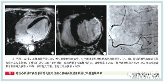 四分之一稳定冠心病有沉默心梗！云南等学者研究