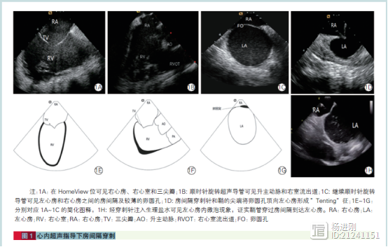 心律失常介入诊疗应用心内超声优势明显！阜外医院方丕华等文章