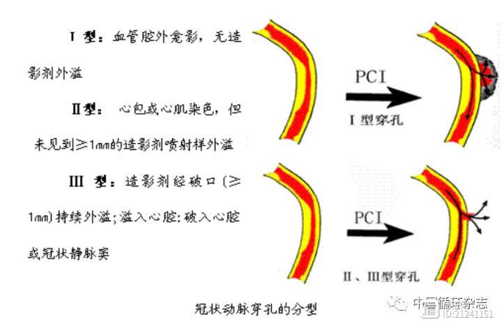 介入术中冠脉穿孔，九成可糊住！阜外医院杨跃进团队研究