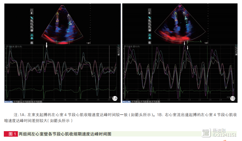 左束支起搏，心脏同步性更好！成都学者研究