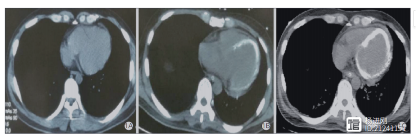 【河北医大二院病例报告】39岁男士的怪病：20天发生心肌弥漫性钙化