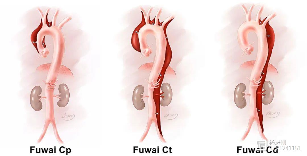 主动脉弓夹层有了阜外分型！于存涛等研究
