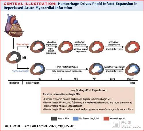 心肌出血，再灌注损伤是主因！JACC研究