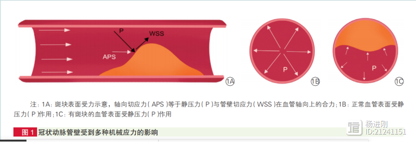 冠脉CT分析流体力学，能预测斑块稳定性吗？解放军总医院学者综述