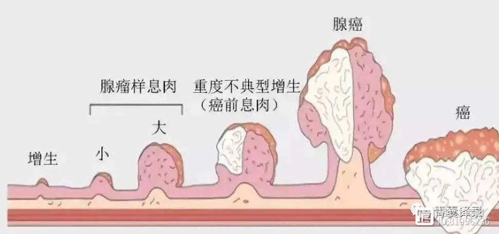 不手术去息肉的良方