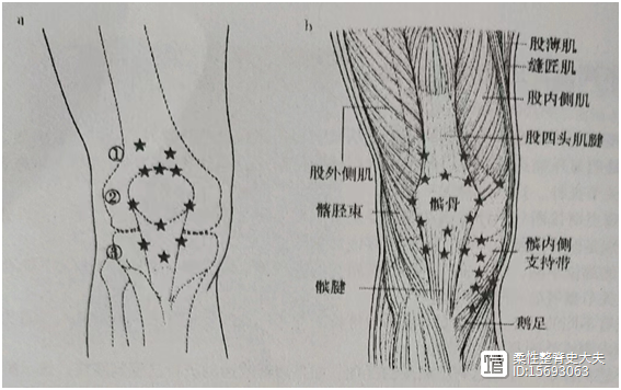膝关节不同部位压痛点的寻找方法(一)