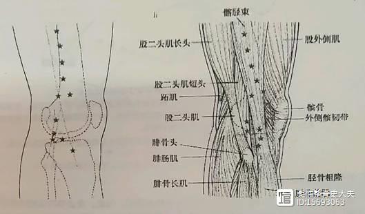 膝关节不同部位压痛点的寻找方法(五)